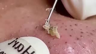 Nose Perfection Popping Giant Blackheads Up Close [upl. by Nahgam416]