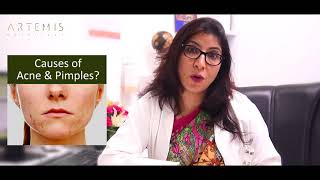 CAUSES OF ACNE amp PIMPLES [upl. by Aiken]