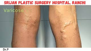 Foam Sclerotherapy treatment for varicose veins  Varicose veins treatment for SSC GD medical [upl. by Etna]