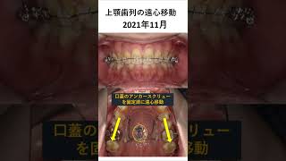 過蓋咬合の矯正歯科治療 歯医者 dentist 歯列矯正 [upl. by Bust]