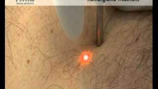 NdYAG Hemangioma Treatment  Skin amp Laser Video [upl. by Erialcyram]