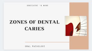 DENTAL CARIES ZONES [upl. by Nosyla]