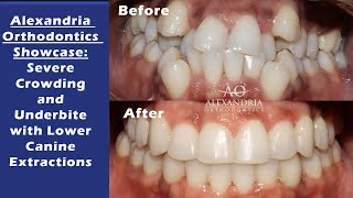 Alexandria Orthodontics Showcase Severe Crowding and Underbite with Lower Canine Extractions [upl. by Valentijn]