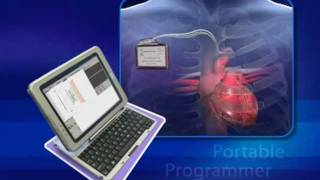 Chronic Heart Failure CHF treatment implantable device [upl. by Gleda]