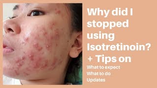 WHY DID I STOPPED USING ISOTRETINOIN  UPDATES  REGIMEN  TIPS [upl. by Dirk657]