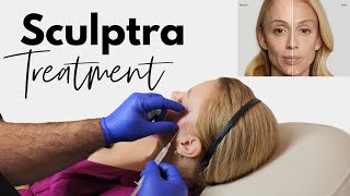 Revitalize Your Look The Ultimate Guide to Sculptra Treatments [upl. by Netty]