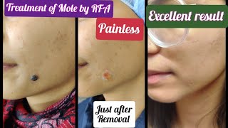 Mole removal by RFA  permanent removal of Melanocytic Nevus Dehradun  Treatment of Mole by RFA [upl. by Ailima]