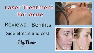 Laser treatment for acne  Reviews benifits Side effects and cost by Noor [upl. by Eartha]