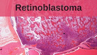 Retinoblastoma  Pathology mini tutorial [upl. by Alaham]