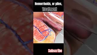 Hemorrhoids or piles surgery and treatment 3danimation viral short [upl. by Yxor]