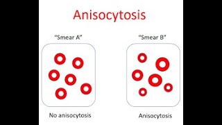 Anisocytosis  Symptoms and Causes  Diagnosis  Treatment  Prevention [upl. by Sharpe]