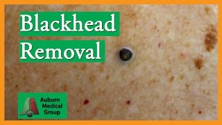 Large Blackhead Removal without Extractor Tool  Auburn Medical Group [upl. by Ainolloppa]