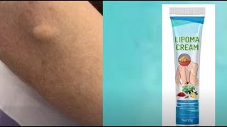 do lipoma removal creams work [upl. by Linet]