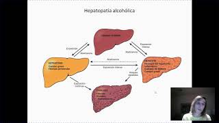 Hepatopatía alcohólica [upl. by Raskin]