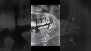 Sharp bending severe curvatures and dilacerated roots of permanent third molars surgical exodontia [upl. by Heilman]