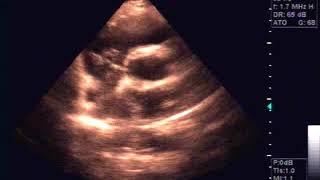 Echocardiography of Hydatide cyst in the interatrial septum [upl. by Merritt]