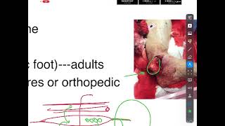 Osteomyelitis [upl. by Reger542]