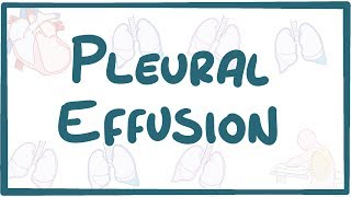 Pleural Effusion  causes symptoms diagnosis treatment pathology [upl. by Aihsyt943]