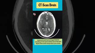 Subarachnoid hemorrhage SAH mri brain radiology shorts [upl. by Ttesil549]