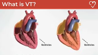 What is Ventricular Tachycardia VT [upl. by Maghutte]