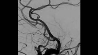 WEB device for small unruptured pericallosal artery aneurysm [upl. by Eldin]