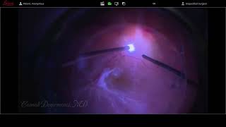 Tractional ve Rhegmatogenous Retinal Detachment in A Patient with Proliferative Diabetic Retinopathy [upl. by Ailahs]