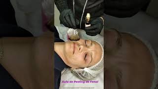 Aplicação de Peeling de Fenol Light harmonizacaoorofacial skincare peeling botox estetica [upl. by Kcireddor396]