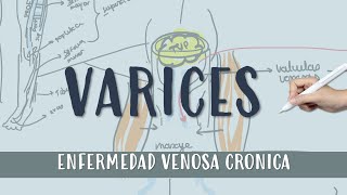 VARICES  Flebitis varices  ENFERMEDAD VENOSA CRONICA [upl. by Theodor]