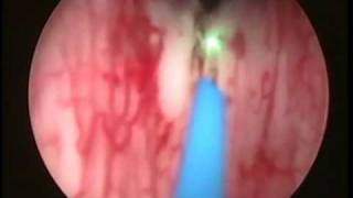 Bladder Neck Incision with Laser [upl. by Bronwyn]