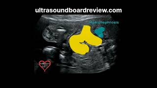 Hydronephrosis Fetal Ultrasound [upl. by Marchelle]