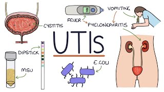 Understanding Urinary Tract Infections [upl. by Suidaht]