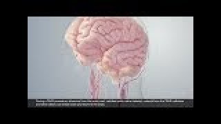 3D Animation of SENTINEL™ Cerebral Protection System [upl. by Colwell]