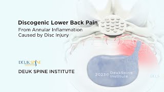 Discogenic Lower Back Pain  3D Animation [upl. by Nido266]