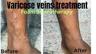 Foam sclerotherapy treatment for varicose veins Miracle of varicose veins treatment varicosevein [upl. by Leonerd]