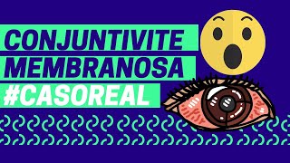 Conjuntivite membranosa 😳  CASO REAL  drolho [upl. by Jelsma]