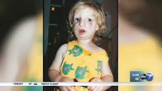 ABC7 Chicago  Teen talks about having Treacher Collins Syndrome as seen in movie Wonder [upl. by Reisman117]