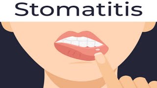 stomatitiscauses of stomatitissymptoms of stomatitisshort [upl. by Rufus30]