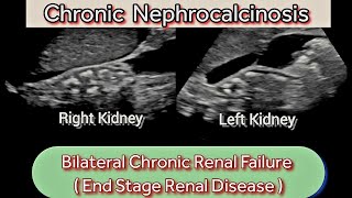 Chronic Renal Disease CKD  Nephrocalcinosis Ultrasound  EndStage Kidneys [upl. by Vere]