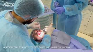 Autotransplantation of mature 3rd Molar [upl. by Hylan]