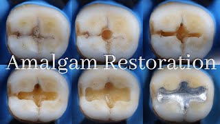 Amalgam Restoration ⚪️ Class I Amalgam Cavity Preparation amp Restoration [upl. by Crow265]