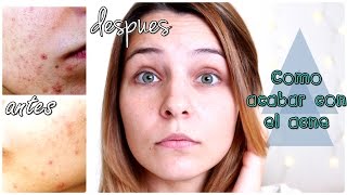 Como eliminar el acné MiHistoria  Epiduo gel Acnemin UNT cosmetics Proderma [upl. by Rogozen]