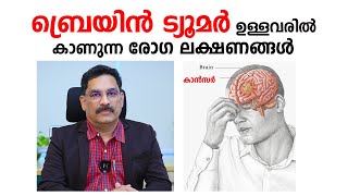 ബ്രെയിൻ ട്യൂമർ ഉള്ളവരിൽ കാണുന്ന രോഗ ലക്ഷണങ്ങൾ  Brain Tumor Symptoms Malayalam  Arogyam [upl. by Rosco]