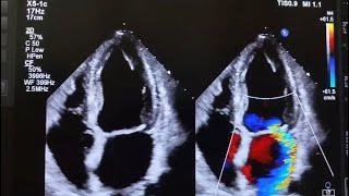 MITRAL VALVE PROLAPSEamp ANNULAR CALCIFICATION WITH SEVERE ECCENTRIC JET MR [upl. by Nylodnew]