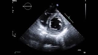 経胸壁心エコー図 急性冠症候群 ACS 5 合併症5 右室梗塞1 [upl. by Jaquiss]