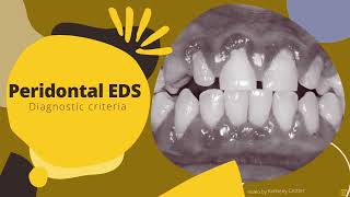 Periodontal EhlersDanlos Syndrome Diagnostic Criteria [upl. by Delos]