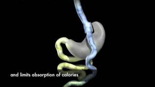 Laparoscopic RouxenY Gastric Bypass Surgery Animation [upl. by Eart]