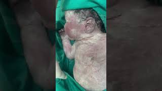 Vernix caseosa a protective sensitive newborn skinnewborn baby ❤️ [upl. by Alister]