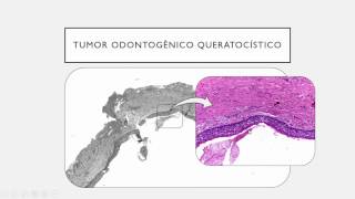 12  TUMORES ODONTOGÊNICOS [upl. by Zerat]