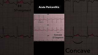 Acute Pericarditis ECG Concave upward STsegment elevation [upl. by Mikahs]