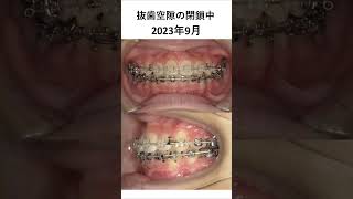 前歯のデコボコの歯列矯正・矯正歯科 歯医者 dentist  美容 [upl. by Merrili]